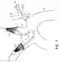Fig. 12 - VASCULAR FILTERS, DEFLECTORS, AND METHODS