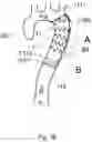 Fig. 08 - Blood conduit with stent