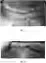 Fig. 11 - Blood conduit with stent