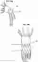 Fig. 10 - Stent-graft