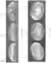 Fig. 34 - Systems, devices and methods of making mammary implants and tissue expanders having ribbed shells