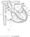 Fig. 03 - Methods for deploying a prosthetic mitral valve