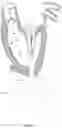 Fig. 10 - Methods for deploying a prosthetic mitral valve