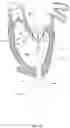 Fig. 11 - Methods for deploying a prosthetic mitral valve