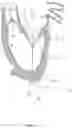 Fig. 21 - Methods for deploying a prosthetic mitral valve