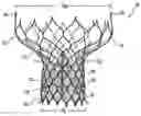 Fig. 01 - Heart valve prosthesis and methods of manufacture and use