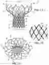 Fig. 02 - Heart valve prosthesis and methods of manufacture and use