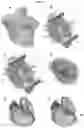 Fig. 04 - Valve prosthesis