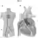 Fig. 05 - Valve prosthesis