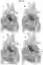 Fig. 11 - Valve prosthesis