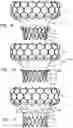 Fig. 15 - Prosthetic heart valve implant