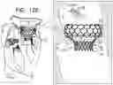 Fig. 17 - Prosthetic heart valve implant