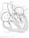 Fig. 31 - Treatment catheter member with encircling function