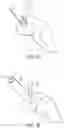 Fig. 09 - PARTIAL JOINT RESURFACING IMPLANT, INSTRUMENTATION, AND METHOD