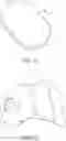 Fig. 12 - PARTIAL JOINT RESURFACING IMPLANT, INSTRUMENTATION, AND METHOD
