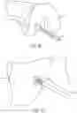 Fig. 16 - PARTIAL JOINT RESURFACING IMPLANT, INSTRUMENTATION, AND METHOD