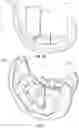 Fig. 08 - Knee prosthesis system and method