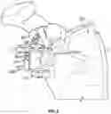 Fig. 03 - Glenoid fossa prosthesis