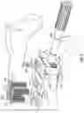 Fig. 06 - Glenoid fossa prosthesis