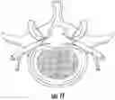 Fig. 04 - Device and method for correcting spinal deformities in patients