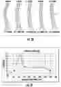 Fig. 06 - Device and method for correcting spinal deformities in patients
