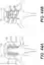 Fig. 34 - Expandable interbody spacer