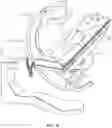 Fig. 16 - Patient-specific pre-operative planning