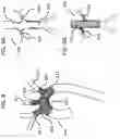 Fig. 10 - FLANGE STENT DEVICE AND MODULAR STENT SYSTEM THEREOF