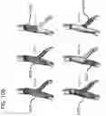 Fig. 12 - FLANGE STENT DEVICE AND MODULAR STENT SYSTEM THEREOF