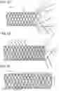 Fig. 03 - WOVEN STENT