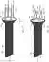 Fig. 17 - Bifurcated implant delivery system