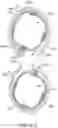 Fig. 32 - Bifurcated implant delivery system