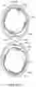 Fig. 33 - Bifurcated implant delivery system