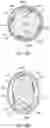 Fig. 42 - Bifurcated implant delivery system