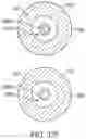 Fig. 55 - Bifurcated implant delivery system