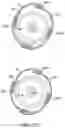 Fig. 71 - Bifurcated implant delivery system
