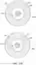 Fig. 74 - Bifurcated implant delivery system