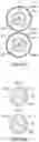 Fig. 83 - Bifurcated implant delivery system