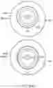Fig. 91 - Bifurcated implant delivery system