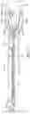 Fig. 95 - Bifurcated implant delivery system