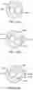 Fig. 25 - Method and apparatuses for deploying an implant