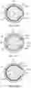 Fig. 35 - Method and apparatuses for deploying an implant