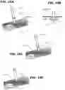 Fig. 08 - Biliary Diversion Catheter