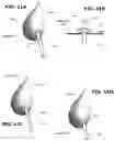 Fig. 09 - Biliary Diversion Catheter