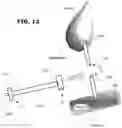 Fig. 10 - Biliary Diversion Catheter