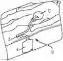 Fig. 01 - DRAINAGE SYSTEM FOR OSTOMY POUCH