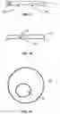Fig. 06 - Corneal implant systems and methods