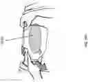 Fig. 32 - Wound closure devices
