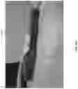 Fig. 40 - Wound closure devices