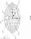 Fig. 69 - Wound closure devices